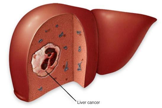 gallbladder, pancreas) o The Big Three Viral Hepatitis