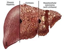 2. Hepatocellular carcinoma HCC is very difficult to treat as most patients
