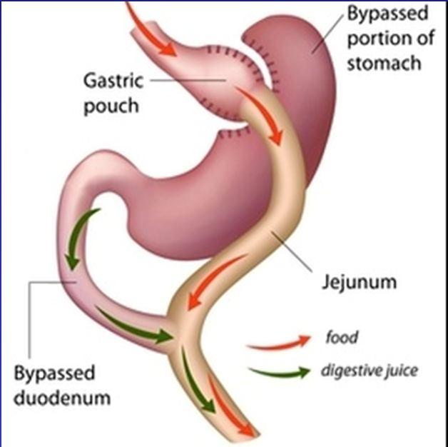 gastric bypass Omega