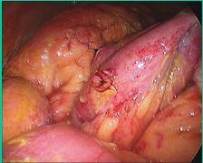 Gastric bypass complications Acute abdominal pain: Anastomotic leak (within 2 weeks) Gallstones: colic, cholecystitis, pancreatitis Ulcer