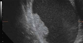 Ultrasound Features for Determining the Risk of Malignancy in Unilocular-Solid Adnexal Masses in Premenopausal Women A search in our database for identifying women who underwent surgery for an