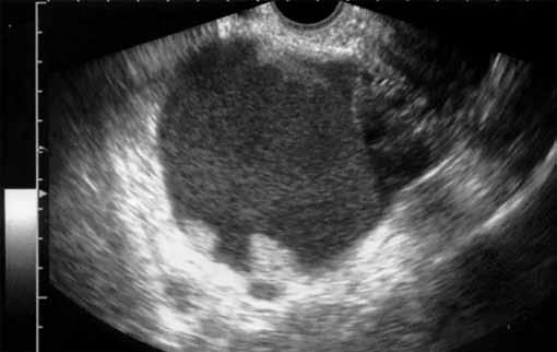 Eligible patients were premenopausal women preoperatively diagnosed as having an adnexal mass categorized as unilocular-solid cyst and evaluated by transvaginal sonography (TVS).