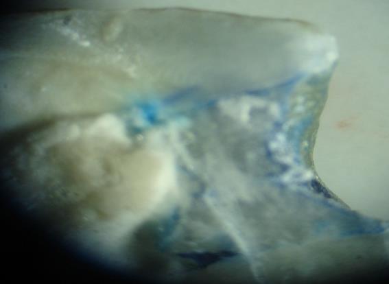 (1):- Grades of dye penetration (11). E: enamel. D: dentine. P: pulp chamber.