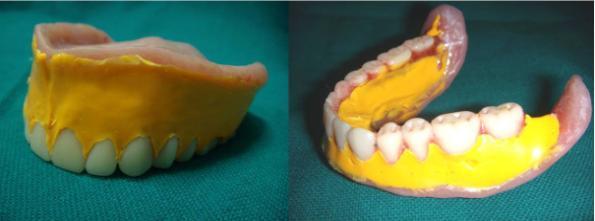 Care was taken during finishing and polishing of the dentures so that the contours recorded previously were unaltered. During insertion the dentures are fully checked to eliminate any minor errors.