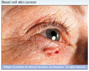 Carcinogenesis: sunlight and