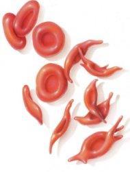 Sickle Cell Disease causes the red blood