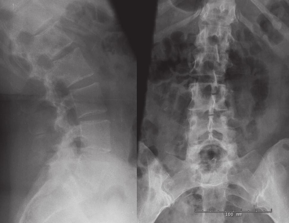 Asian Spine Journal Lumbar fusion after lumbar arthroplasty 15 Table 2. Summary of the ODI and back pain VAS values for the five patients Case No.
