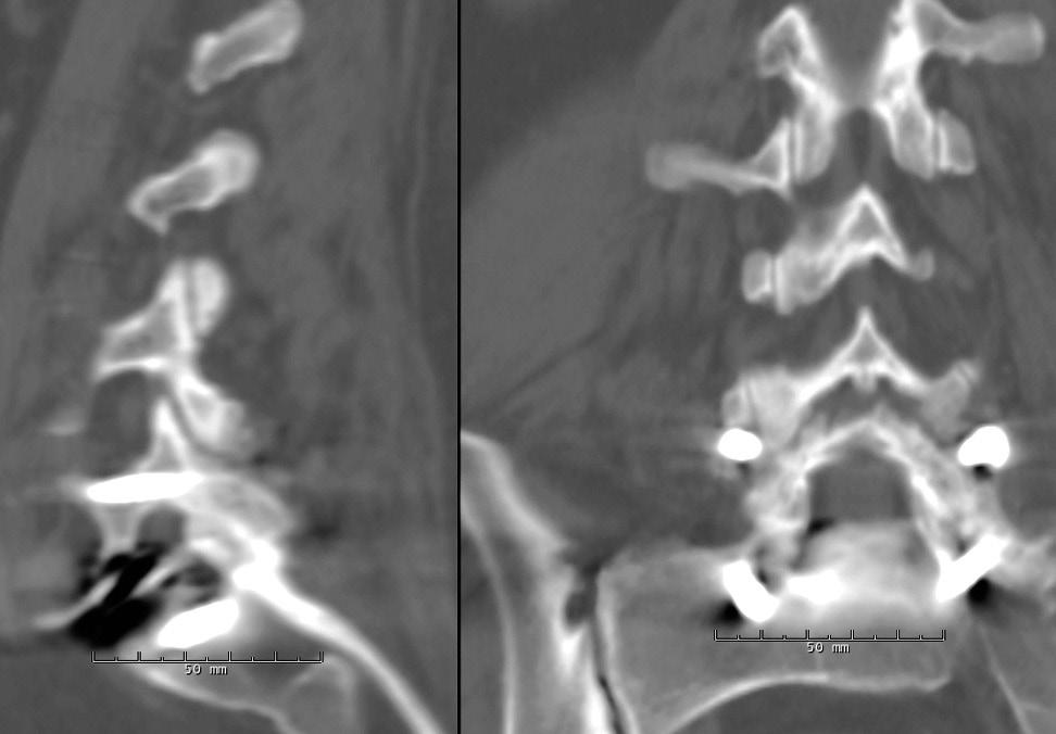 The patient underwent L5 S1 posterolateral fusion with pedicle screws without removing the artificial disc.