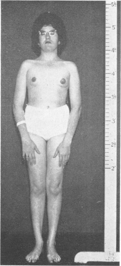 The XY Gonadal Agenesis Syndrome Physical Examination of the Proposita At the age of 21 years (Figs. 1 and 2) her height was 160 cm and she weighed 52-16 g.