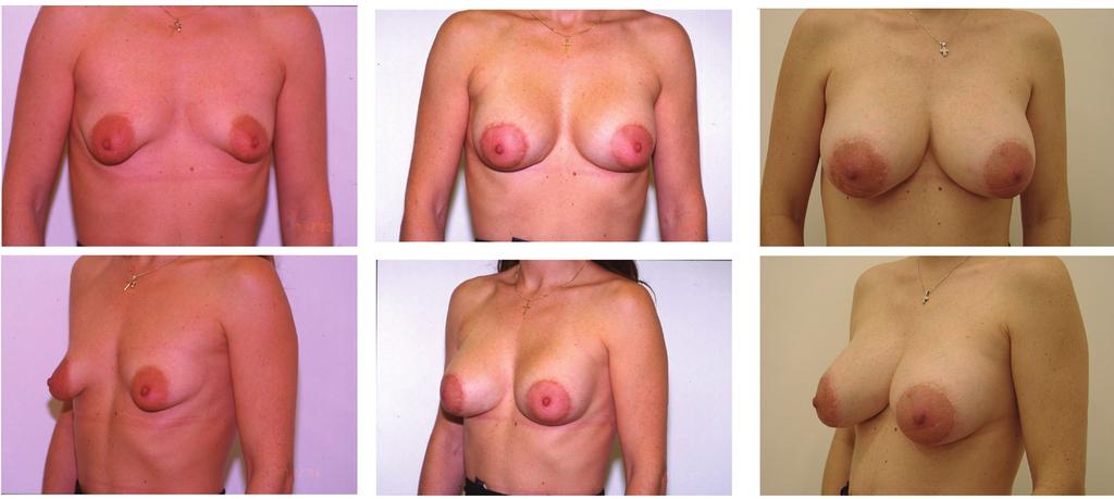 Vol. 112, No. 4 / TUBEROUS BREAST DEFORMITY RECONSTRUCTION 1103 FIG. 4. Thirty-year-old patient (case 3) with bilateral type II tuberous breast deformity.