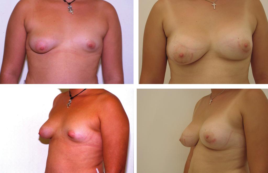1104 PLASTIC AND RECONSTRUCTIVE SURGERY, September 15, 2003 FIG. 6. Seventeen-year-old patient (case 6) with bilateral asymmetrical tuberous breast deformity.