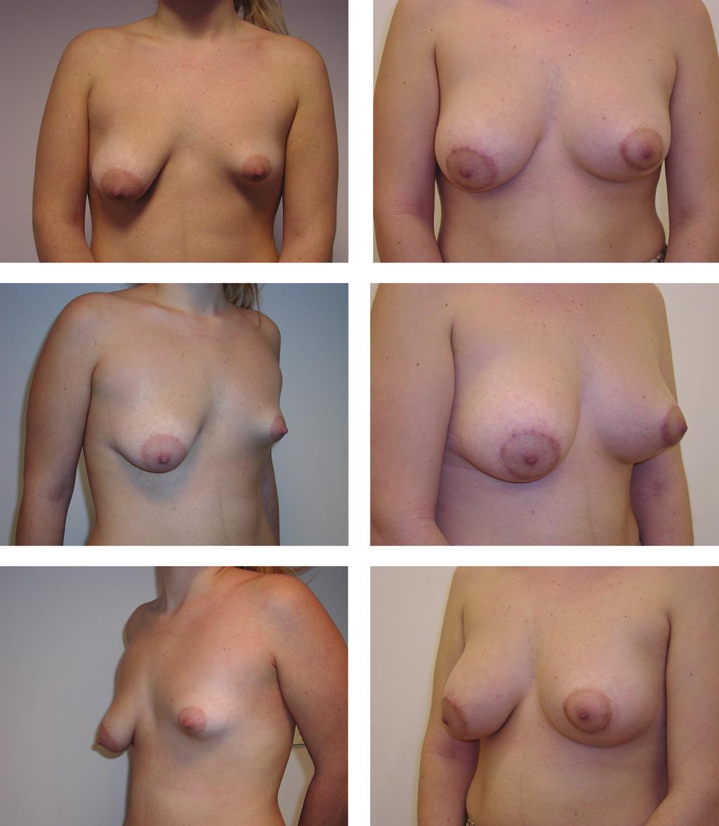 1106 PLASTIC AND RECONSTRUCTIVE SURGERY, September 15, 2003 FIG. 8. Twenty-one-year-old patient (case 11) with asymmetrical tuberous breast deformity.