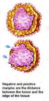 on microscopic examination, the cancerous cells invade and replace the surrounding