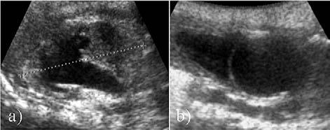 316 Otilia Fufezan et al Large spectrum of complete urinary collecting system duplication exemplified by cases Fig 1.