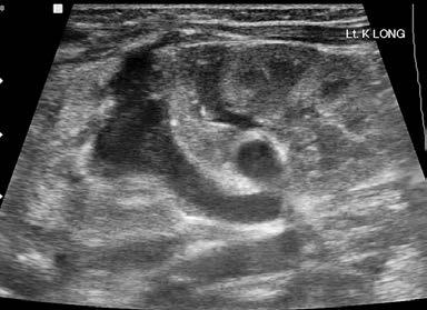 Case 1: a) Longitudinal scan of the left kidney after therapy (ureterocele puncture): there is no dilatation of the upper CS; b) Longitudinal scan of the urinary bladder ureterocelesignificantly
