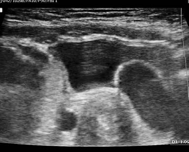 US and computed tomography showed bilateral duplex CS with hypodysplastic right upper moiety and right ectopic extravezical ureter (with the distal end implanted in the vagina), responsible for