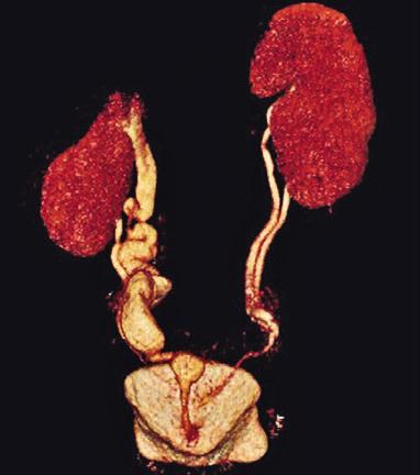 narrowing of the right kidney parenchyma. Fig 7.