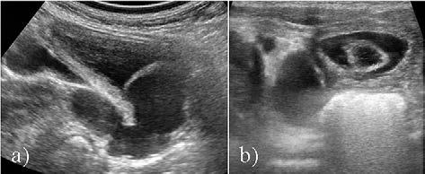 hypodisplastic aspect of the right upper pole, right upper ureter is dilated and tortuous with an extravesical