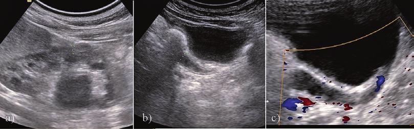 Case 5: a) Left kidney US, longitudinal scan: CS duplication with dilatation of the lower pelvicalicealsystem, reduced lower moiety