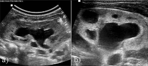 Case 5: Magnetic resonance urography confirms duplex CS with significant distension of the lower pole,