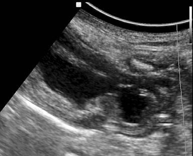 Case 6: Longitudinal scan of the symphysis pubis (in neonates is incomplete ossified and permits proximal