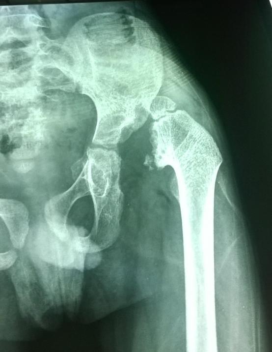 Evaluation of the Results of Operative Treatment of Hip Dysplasia in Children after the walking age DISCUSSION There always will be children who reach ambulatory age with developmental dysplasia of