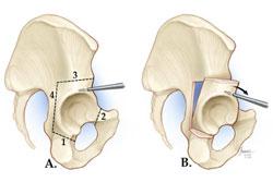 treat hip dysplasia is an osteotomy. "Osteotomy" literally means "cutting of the bone.