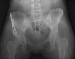 In this x-ray image, the acetabulum has been repositioned during surgery and held in place with screws. Arthroscopy.