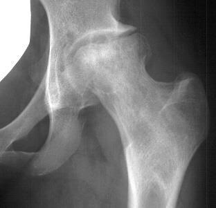 Complications Osteonecrosis Rare Salvage with THA Trochanteric bursitis/pain 45-75% Described as