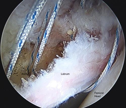 Arthroscopic Approach Confirmed importance of