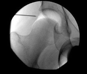 Complications Generally low Cartilage injury from instruments: 10% Heterotopic ossification: