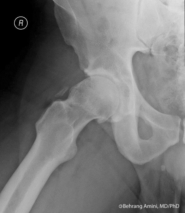 Imaging of Hip Dunn view