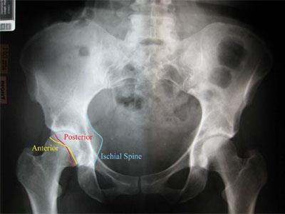 Imaging of the hip Degree of retroversion