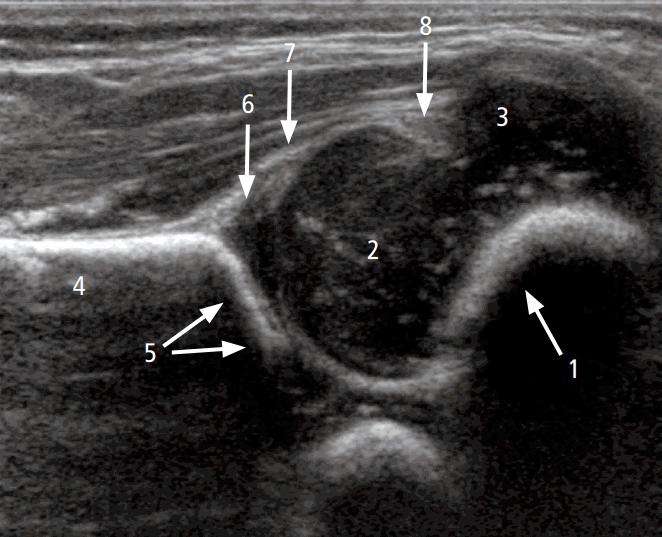 Superior Lateral Sonographic Appearance Egg-in-a-spoon in a coronal plane Inferior Medial 1, chondro-osseous junction between the bony part and the cartilaginous part of the femoral neck; 2,