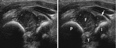 Normal Transverse showing cup-like appearance formed by metaphysis & ischium F= femoral