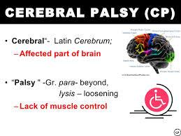 Cerebral Palsy Spastic gait Diagnostic challenge in mild CP Hx: premature,