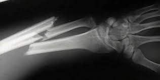 Remodeling of Children s Fractures Occurs by physeal &