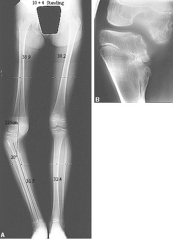 Growth Arrest Secondary to Growth Plate Injury Complete cessation of longitudinal growth = limb
