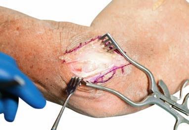 replacement. The skin incision can be made either posteriorly, directly over the olecranon, or over the lateral aspect of the elbow.