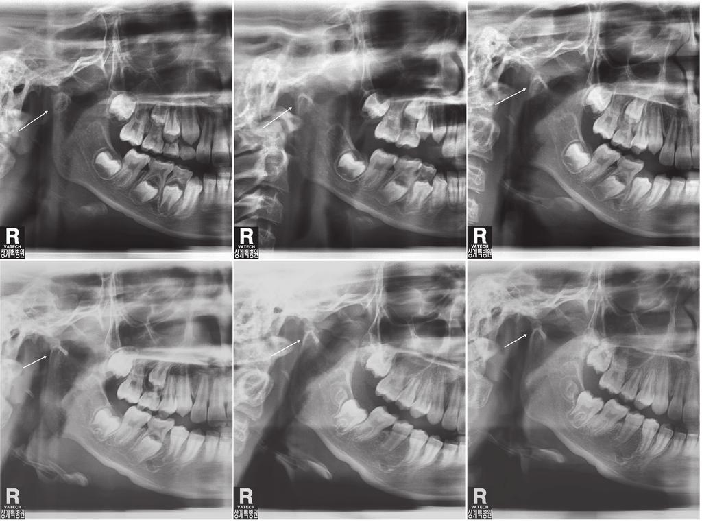 Min-Ho Woo et al A B C D E F Fig. 3. Panoramic radiographs reveal the remodeling process of the fractured right condylar head at 6-month intervals. A. The white arrow indicates a deviated right condylar head.