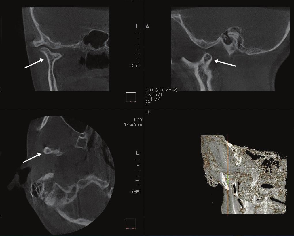 Post-traumatic bifid mandibular condyle: A case report and literature review A B C D Fig. 4. Cone-beam computed tomo graphy images demonstrate the ap pearance of the bifid mandibular condyle. A. Coronal image.