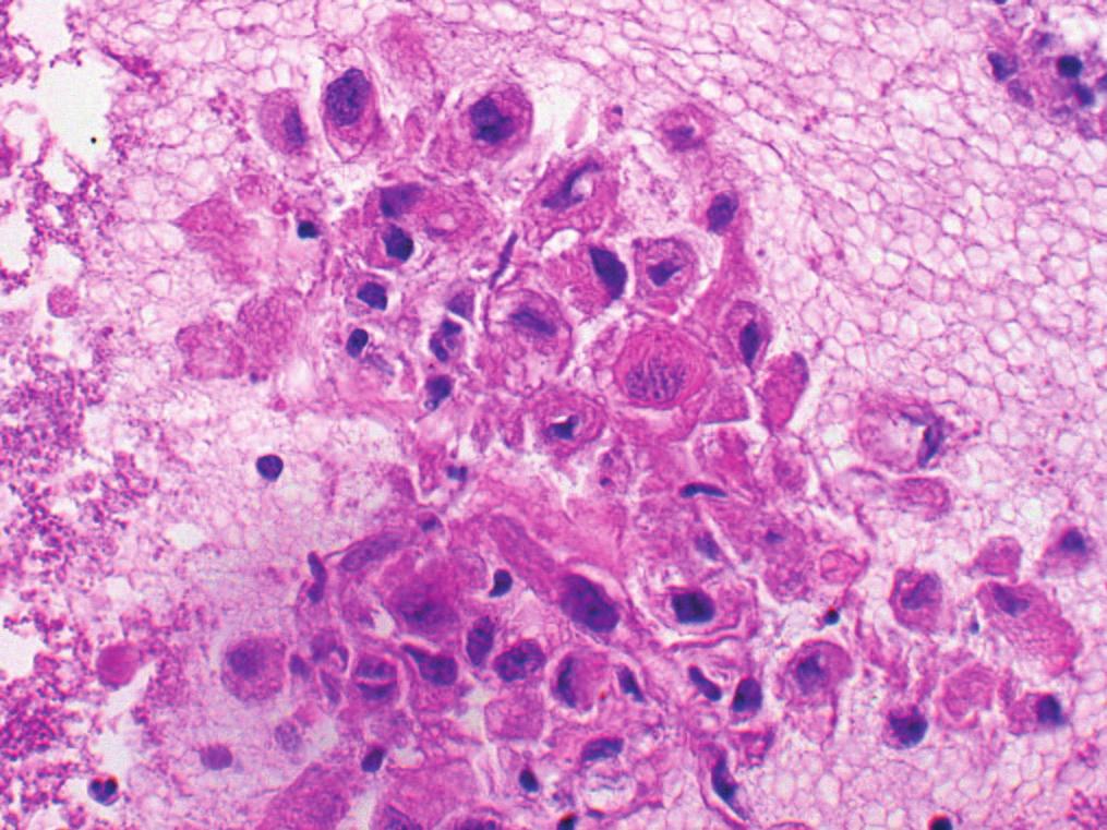 Note the predominance of cohesive spindleshaped epithelial cells and the relatively inconspicuous lymphocytes. Hematoxylin and eosin (H&E) stain. FIGURE 3.