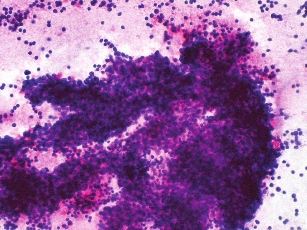 FIGURE 2. Case 20: Fine needle aspiration (FNA) of a lymphocyte-rich, type B2 where the majority of the cells are reactive lymphocytes, and fewer epithelial cells are seen. Diff-Quik stain. FIGURE 4.