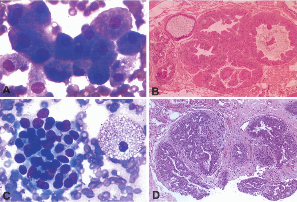10 Annals of Clinical & Laboratory Science, vol. 41, no. 1, 2011 Fig. 1. Panel A: Imprint cytology of a core needle biopsy of a benign breast lesion demonstrating a cluster of apocrine cells (DiffQuick, x600).
