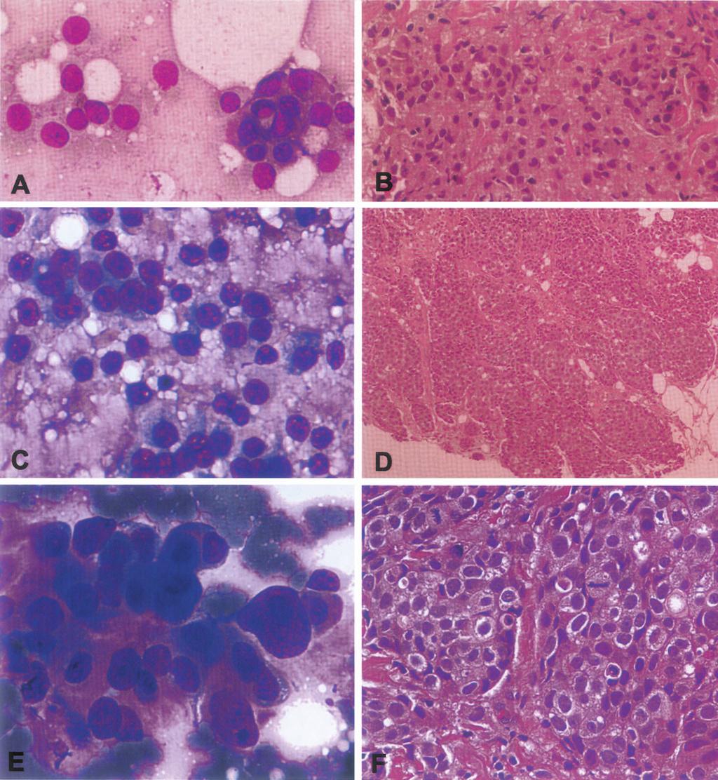 Imprint cytology during image-guided core biopsy of breast 11 Fig. 2.