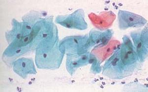 PAP smear showing normal