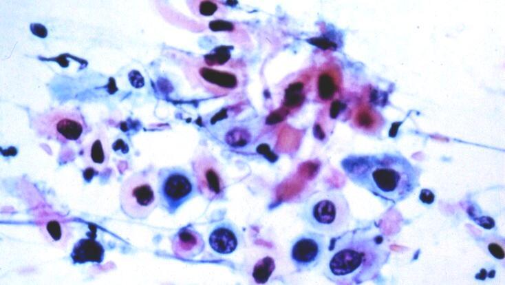 Sq.cells Pleomorphism ;