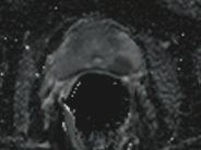 biopsy underwent 3.0T MRI with SENSE Torso and Endo coil.