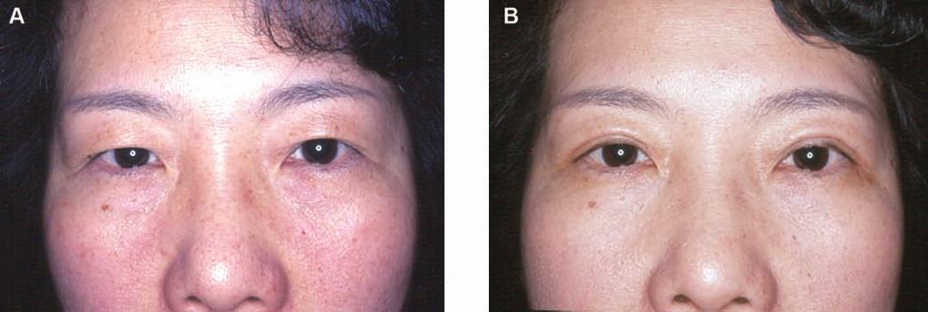 174 Aesthetic Surgery Journal 31(2) Figure 5. (A) This 59-year-old woman presented with dermatochalasis of her upper eyelids, along with pseudoptosis. A 9-mm skin-muscle resection was planned.