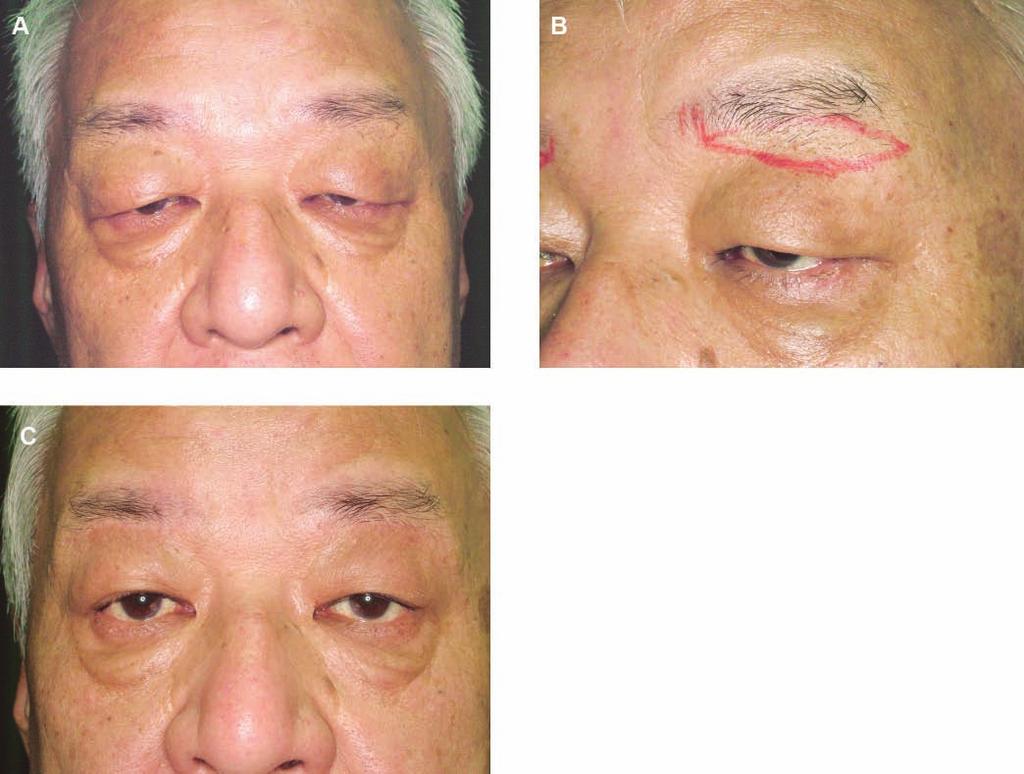 Takayanagi 175 Figure 7. (A) This 68-year-old man presented with dermatochalasis of his upper eyelids, along with pseudoptosis.